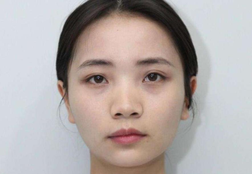 鼻梁上有横纹图片 女人鼻梁上有横纹图片